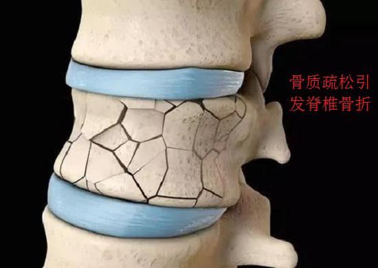 脊柱疏松引发椎体骨折