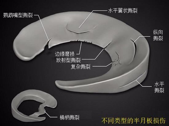 不同类型的半月板损伤 不同类型的半月板损伤