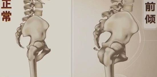 骨盆前倾、腰椎曲度变大的改善思路(人中长痘)图1